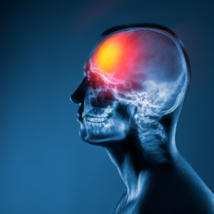 Chronic Traumatic Encephalopathy and testamentary capacity to sign a will explained by a Dallas estate planning attorney